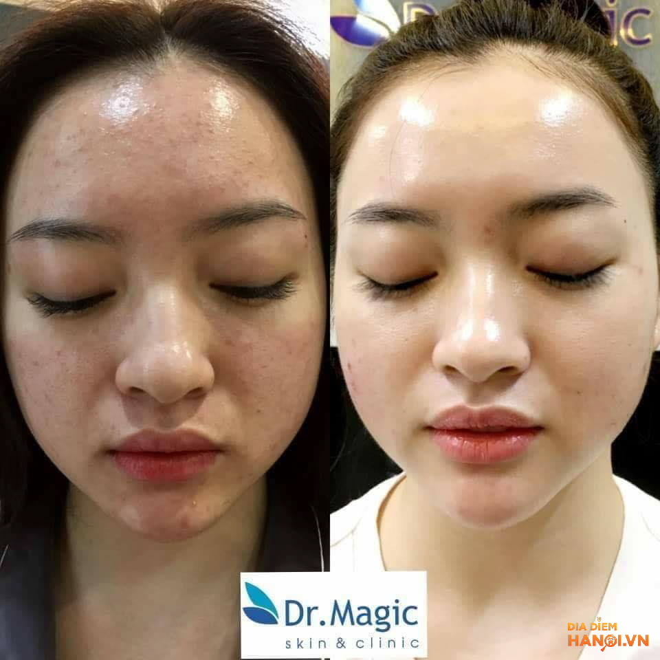khách hàng điều trị mụn tại Dr Magic Skin & Clinic